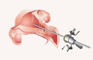 Диагностическая гистероскопия цена Киев