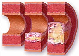 Эндартериит симптомы, лечение