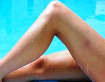 Эхосклеротерапия киев