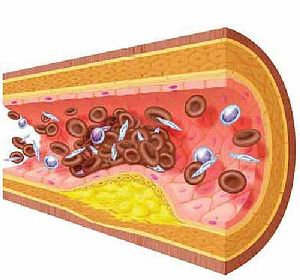 obliteriruyuschiy-ateroskleroz-sosudov