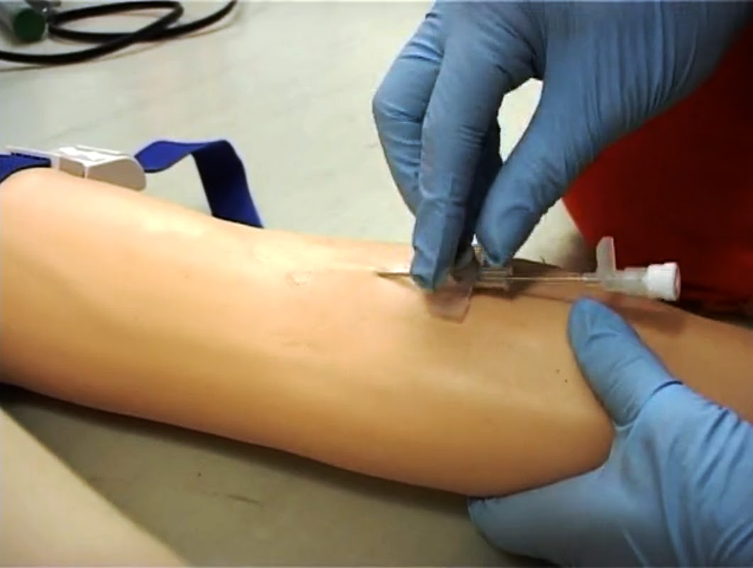 Лечение варикоза радиоволнами