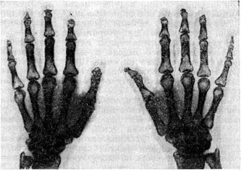 Как лечить синдром Рейно?