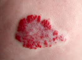 Иссечение гемангиомы