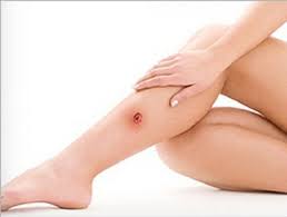 Трофические язвы на голени