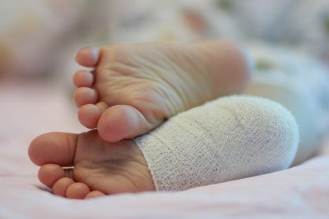 Варикоз (грибок) лечение