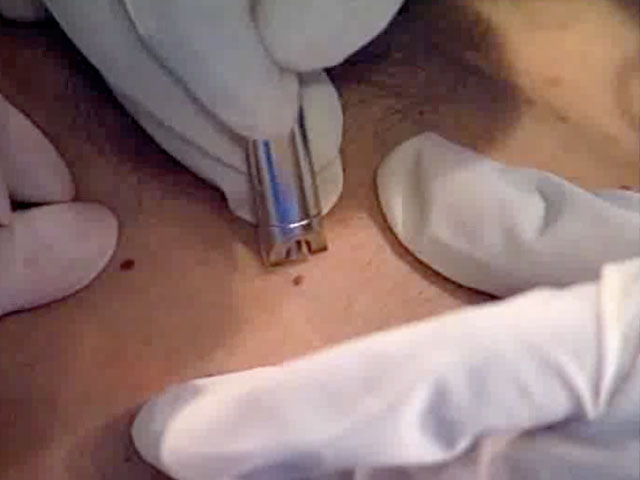 Лечение гемангиомы лазером