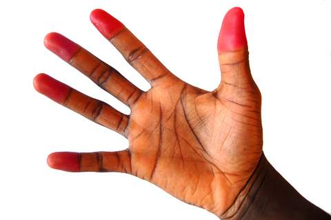 Синдром Рейно: симптомы, лечение