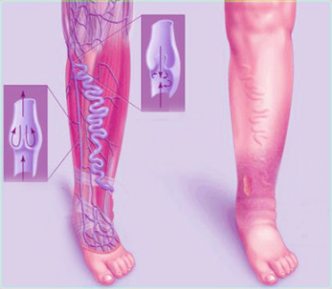 Хроническая венозная недостаточность нижних конечностей