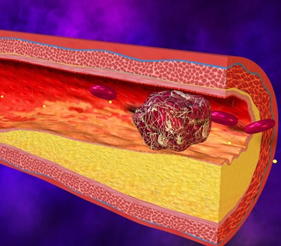 Формирование тромба