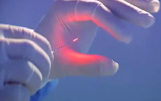 Лазерная коагуляция варикозных вен