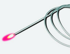 Эндоваскулярная лазерная коагуляция вен