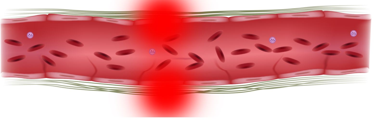 Воспаление стенок кровеносных сосудов