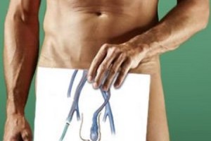 Лечение варикоцеле в Киеве