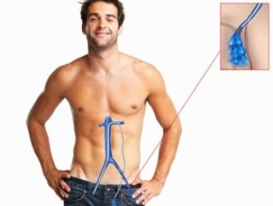 Склеротерапия при варикоцеле