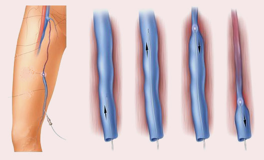Варикозное расширение вен лечение (операция)