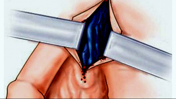 Боль в яичке лечение (при варикоцеле)