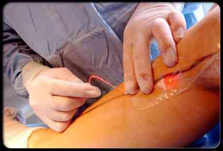 Варикозное расширение вен - лечение лазером