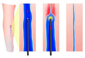 Консультация врача флеболога. Что такое варикозные сосуды?