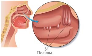 Полипы у детей лечение Киев