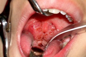 Adenoidy-u-detej-3-stepeni