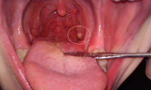 Ангина симптомы