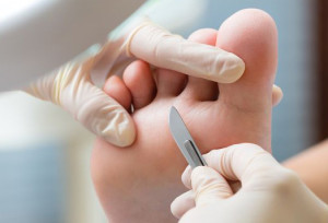 Лечение подошвенных бородавок