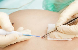 Уход за обработанной зоной, уход после удаления фурункула