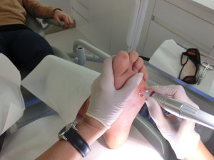 Лазеротерапия бородавок