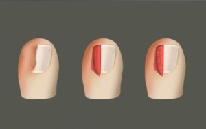 Что такое вросший ногть?