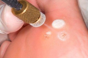 Удаление подошвенной бородавки в Киеве