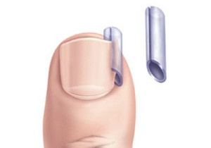 Методы лечения вросшего ногтя. Лазерное лечение вросшего ногтя Киев