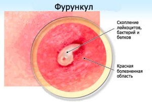 Что такое фурункул? Симптомы фурункула