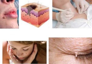 Что такое биопсия бородавки? Бородавки – проявление вируса папилломы человека и цель определения характера патологического процесса