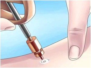 Соскоб кондиломы. Диагностика кондиломы (иссечение кондиломы)