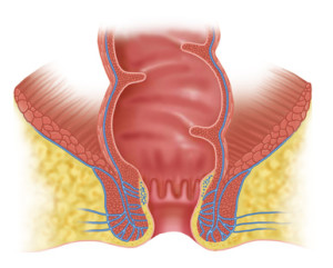 Что такое трещина анального прохода?