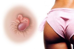 Что такое наружный геморрой?