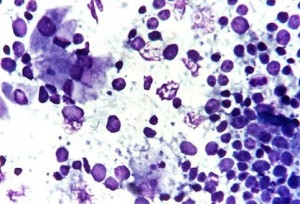 Признаки цервицита