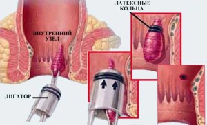 Лечение геморроя форум, как лечить наружный геморрой, геморрой лечение фото, геморрой причины, геморрой мазь, геморрой признаки у женщин и мужчин